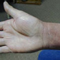 healed hand