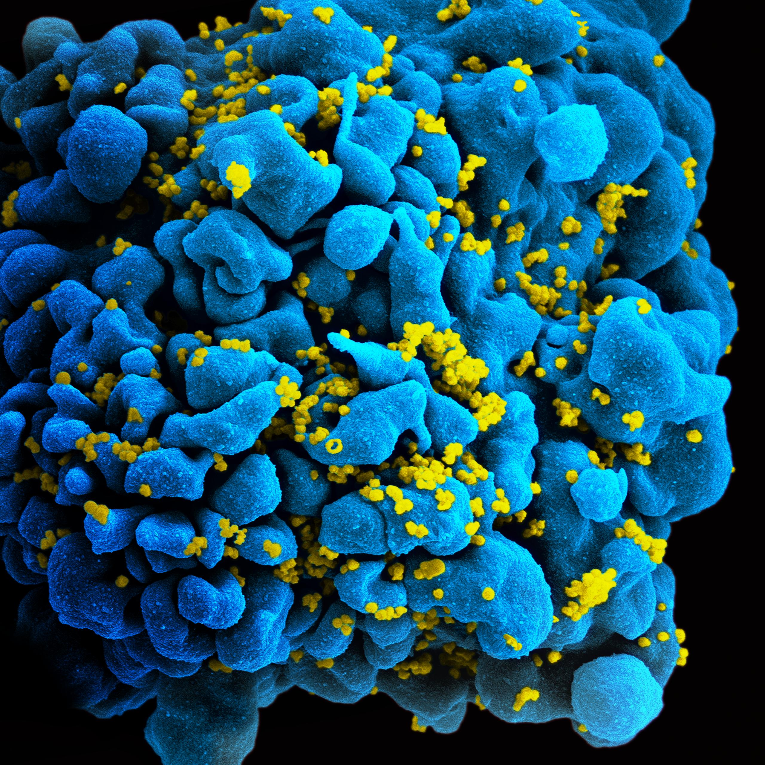 microscopy of HIV-infected T-cell
