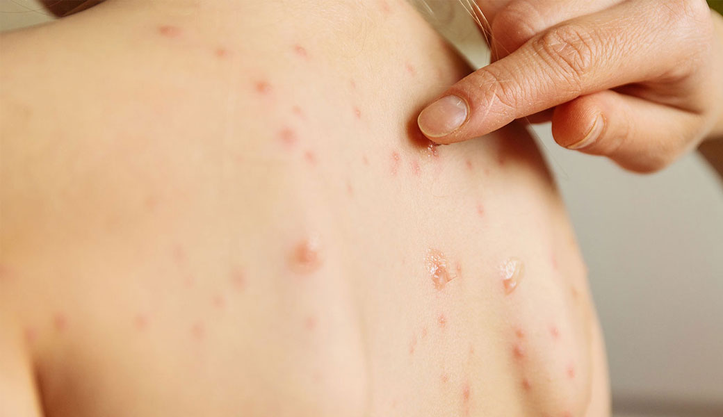 Varicella zoster virus, the type of herpes that causes both chickenpox and shingles, causes an itchy, painful rash. No effective treatment currently exists for the virus. (Getty Images)