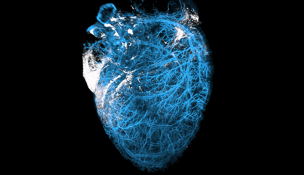 The parasite that causes Chagas disease can cause inflammation in the heart, as shown in white here in a mouse model.
