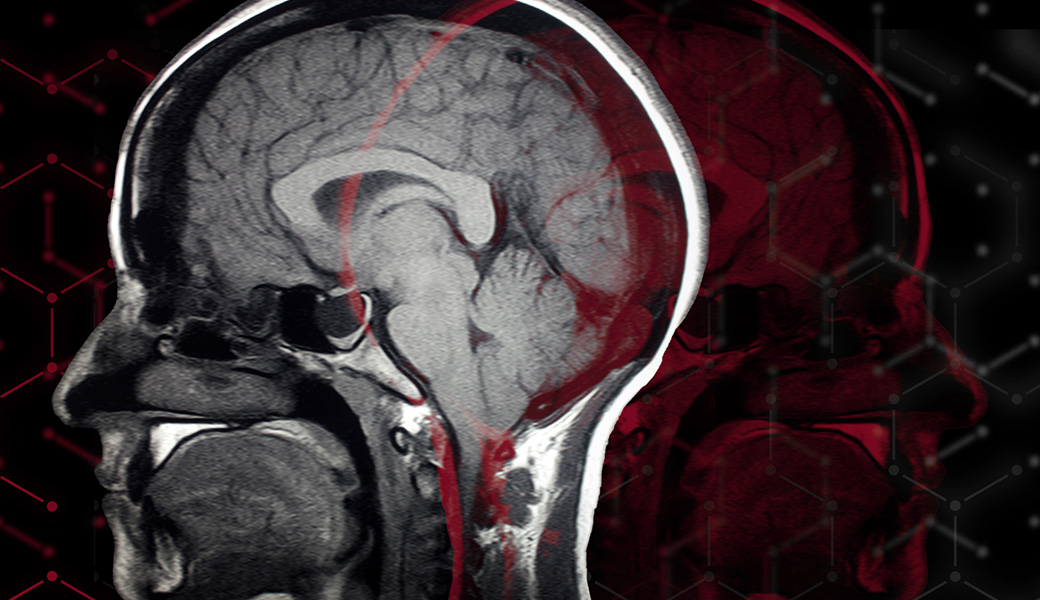 Health & Wellness • Science & Technology New compound may help the brain heal itself after injury 22 seconds agoby Charlene Betourney A detailed image of a human brain scan. There are currently no FDA-approved drugs that directly repair or prevent brain damage following TBI, a major gap in treatment. (Illustration by Lindsay Robinson)