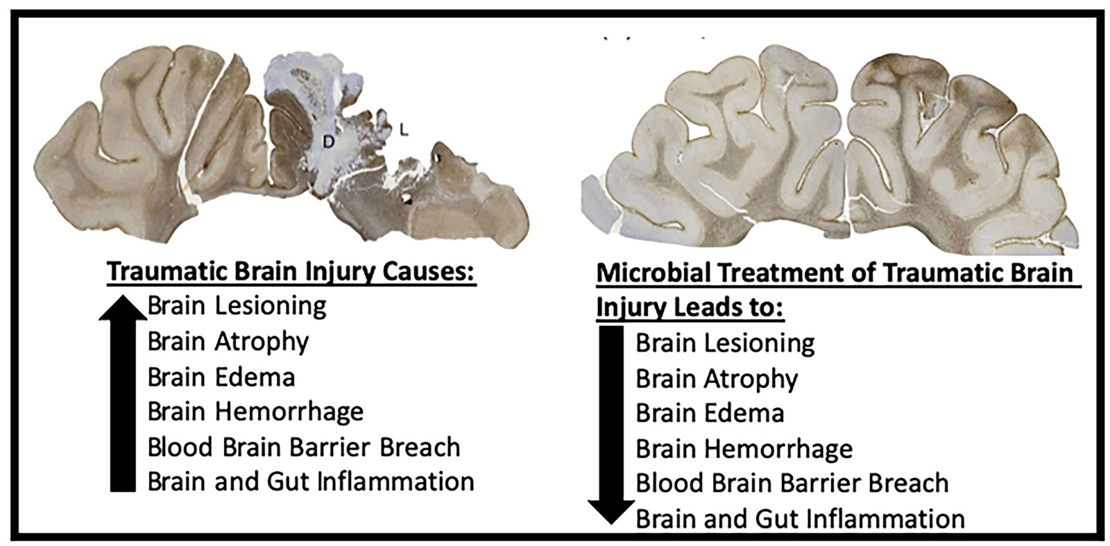 Gut Microbial Therapy for Traumatic Brain Injury